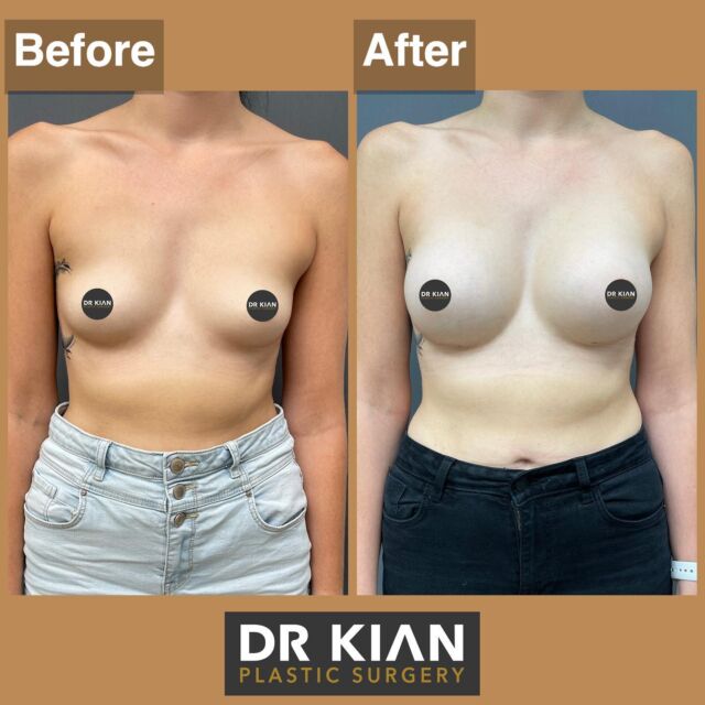 Fat Transfer Manchester Face Breast Dr Kian Plastic Surgery